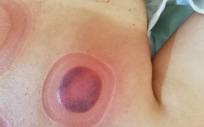 Cosa sono i segni sulla schiena dei nuotatori olimpici?