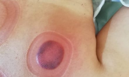 Cosa sono i segni sulla schiena dei nuotatori olimpici?